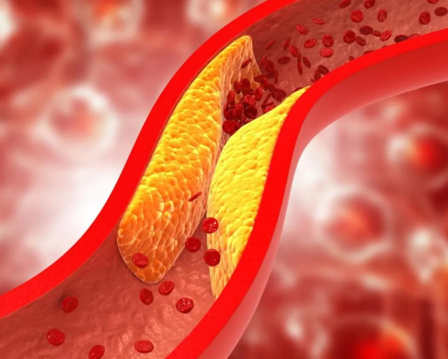 علاج جيني جديد يخفض الكوليسترول "الضار" والدهون الثلاثية للنصف